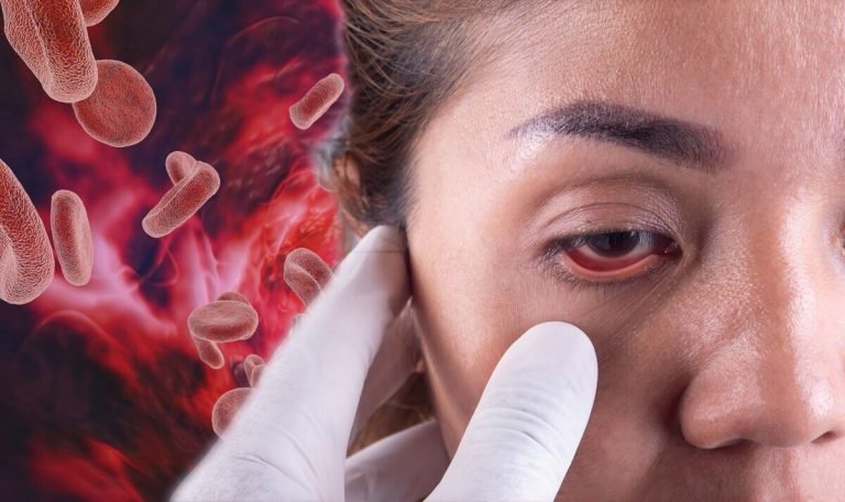 Diabetes and Your Eyes