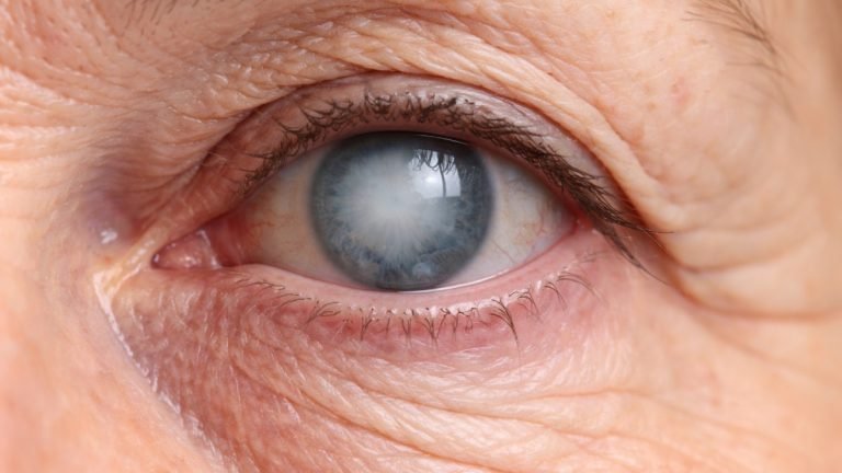 cataract